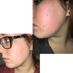 کرم مرطوب کننده سراوی CERAVE حجم 454 گرم | مناسب پوست خشک و بسیار خشک 10 before after zhinora ordinary salicylic acid solut 14