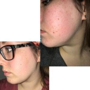 before after zhinora ordinary salicylic acid solut 14