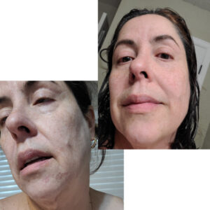 before after zhinora ordinary salicylic acid solut 15