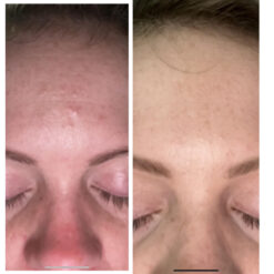 سرم رتینول سراوی پوست چرب و مختلط (100%اصل+به قیمت پخش) آبی ضد جوش 46 before after zhinora ordinary salicylic acid solut 2