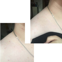 ژل شسستشو سراوی (100%اصل+به قیمت پخش) SA پوست زبر و خیلی خشک 15 before after zhinora ordinary salicylic acid solut