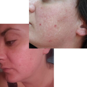 before after zhinora ordinary salicylic acid solut 3