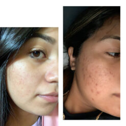 سرم رتینول سراوی پوست چرب و مختلط (100%اصل+به قیمت پخش) آبی ضد جوش 39 before after zhinora ordinary salicylic acid solut 4