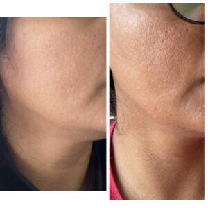 before after zhinora ordinary salicylic acid solut 5