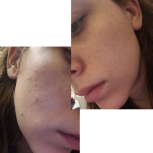 before after zhinora ordinary salicylic acid solut 6