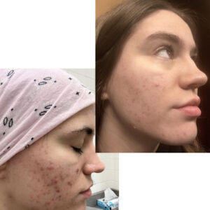 before after zhinora ordinary salicylic acid solut 7