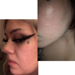 سرم رتینول سراوی پوست چرب و مختلط (100%اصل+به قیمت پخش) آبی ضد جوش 35 before after zhinora ordinary salicylic acid solut 8