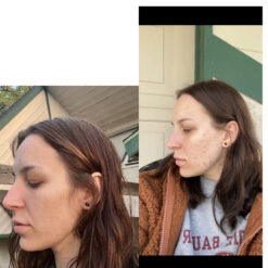 سرم رتینول سراوی پوست چرب و مختلط (100%اصل+به قیمت پخش) آبی ضد جوش 34 before after zhinora ordinary salicylic acid solut 9