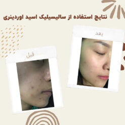 سرم سالسیلیک اسید اوردینری (100%اصل+به قیمت پخش) 13 before after zhinora ordinary salicylic acid solution 01