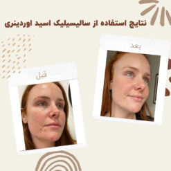 سرم سالسیلیک اسید اوردینری (100%اصل+به قیمت پخش) 12 before after zhinora ordinary salicylic acid solution 02