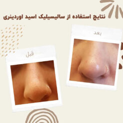 سرم سالسیلیک اسید اوردینری (100%اصل+به قیمت پخش) 11 before after zhinora ordinary salicylic acid solution 03