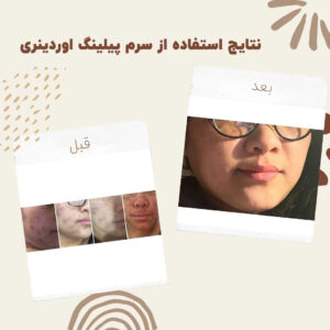 before after zhinorapeeling min