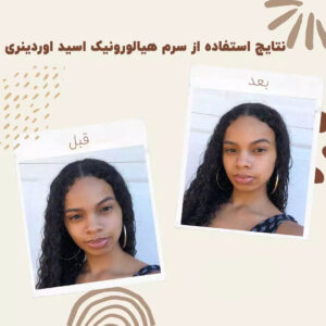 hyaloronic asid before after