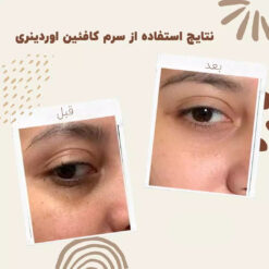 سرم کافئین اوردینری (100%اصل+به قیمت پخش) ضد تیرگی و پف دور چشم 16 ordinary caffeine eye serum before after 1
