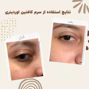 ordinary caffeine eye serum before after 1
