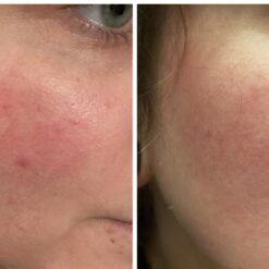 سرم رتینول سراوی پوست چرب و مختلط (100%اصل+به قیمت پخش) آبی ضد جوش 56 رتینول سراوی 4