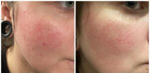 سرم رتینول سراوی پوست چرب و مختلط (100%اصل+به قیمت پخش) آبی ضد جوش 85 رتینول سراوی 4