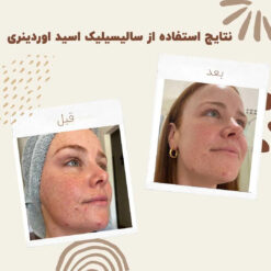 سرم سالسیلیک اسید اوردینری (100%اصل+به قیمت پخش) 17