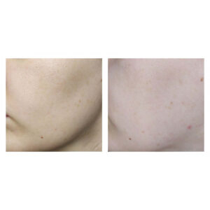 شستشوی سالیسیلیک اسید سراوی CeraVe SA Smoothing Cleanser 5