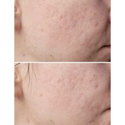 شوینده سراوی ضد جوش و آکنه (100%اصل+به قیمت پخش) بلمیش ضد جوش پوست 17 شستشوی صورت ضد لک و جوش سراوی Cerave Blemish Control Cleanser 236ml 7 768x768 1