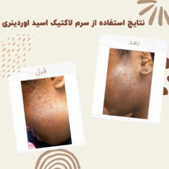 سرم لاکتیک اسید اوردینری (100%اصل+ارسال فوری) 19 before after Lactic Acid 1 min