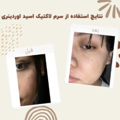 سرم لاکتیک اسید اوردینری (100%اصل+ارسال فوری) 18 before after Lactic Acid 2 min