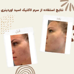 سرم لاکتیک اسید اوردینری (100%اصل+ارسال فوری) 17 before after Lactic Acid 3 min