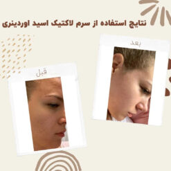 سرم لاکتیک اسید اوردینری (100%اصل+ارسال فوری) 16 before after Lactic Acid 4 min