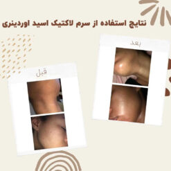 سرم لاکتیک اسید اوردینری (100%اصل+ارسال فوری) 15 before after Lactic Acid 5 min