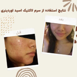 سرم لاکتیک اسید اوردینری (100%اصل+ارسال فوری) 14 before after Lactic Acid 6 min