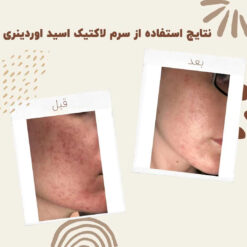 سرم لاکتیک اسید اوردینری (100%اصل+ارسال فوری) 13 before after Lactic Acid 7 min