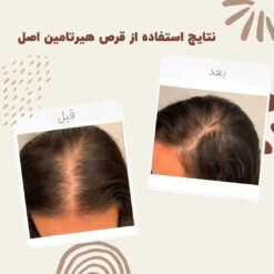 قرص هیرتامین (100%اصل+ارسال فوری) تقویت مو ناخن 13 before after hairtamin 1 1