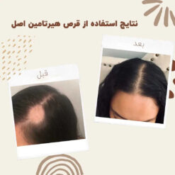 قرص هیرتامین (100%اصل+ارسال فوری) تقویت مو ناخن 12 before after hairtamin 2 1