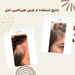 قرص هیرتامین (100%اصل+ارسال فوری) تقویت مو ناخن 9 before after hairtamin 5 1