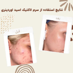 سرم لاکتیک اسید اوردینری (100%اصل+ارسال فوری) 12 before after ordinary lactic acid 01 min