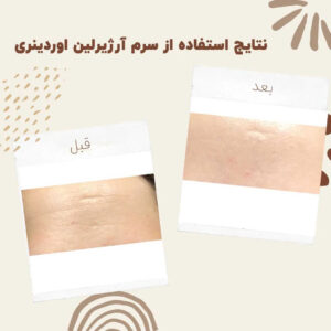 before after zhinora ordinary argireline 1 min