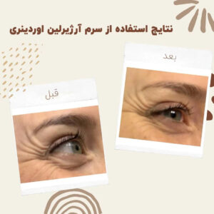 سرم آرژیرلین اوردینری (100%اصل+ارسال فوری) 10درصد 16 before after zhinora ordinary argireline 2 min