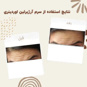 before after zhinora ordinary argireline 3 min