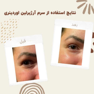 before after zhinora ordinary argireline 4 min