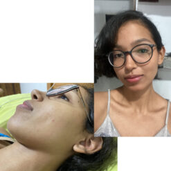 فوم شستشوی صورت سراوی پوست چرب و نرمال (اصل+به قیمت پخش) 25 before after zhinora ordinary salicylic acid solution 05 510x510 1