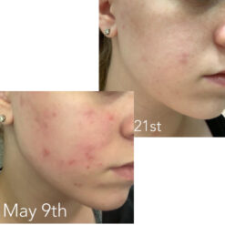 فوم شستشوی صورت سراوی پوست چرب و نرمال (اصل+به قیمت پخش) 24 before after zhinora ordinary salicylic acid solution 05 510x510 2