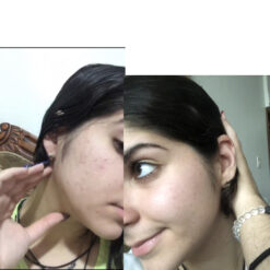 فوم شستشوی صورت سراوی پوست چرب و نرمال (اصل+به قیمت پخش) 23 before after zhinora ordinary salicylic acid solution 05 510x510 3