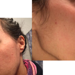 فوم شستشوی صورت سراوی پوست چرب و نرمال (اصل+به قیمت پخش) 22 before after zhinora ordinary salicylic acid solution 05 510x510 5