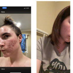 فوم شستشوی صورت سراوی پوست چرب و نرمال (اصل+به قیمت پخش) 21 before after zhinora ordinary salicylic acid solution 05 510x510 6