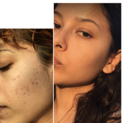 فوم شستشوی صورت سراوی پوست چرب و نرمال (اصل+به قیمت پخش) 20 before after zhinora ordinary salicylic acid solution 05 510x510 8