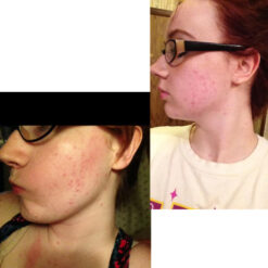 فوم شستشوی صورت سراوی پوست چرب و نرمال (اصل+به قیمت پخش) 26 before after zhinora ordinary salicylic acid solution 05 510x510 9