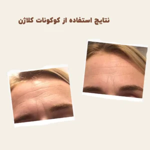 before after myvitamins coconut collagen 3