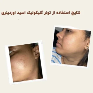 before after Glycolic Acid 1 min