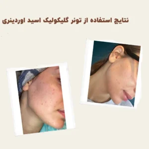 before after Glycolic Acid 10 min