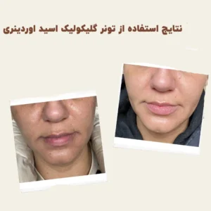before after Glycolic Acid 11 min